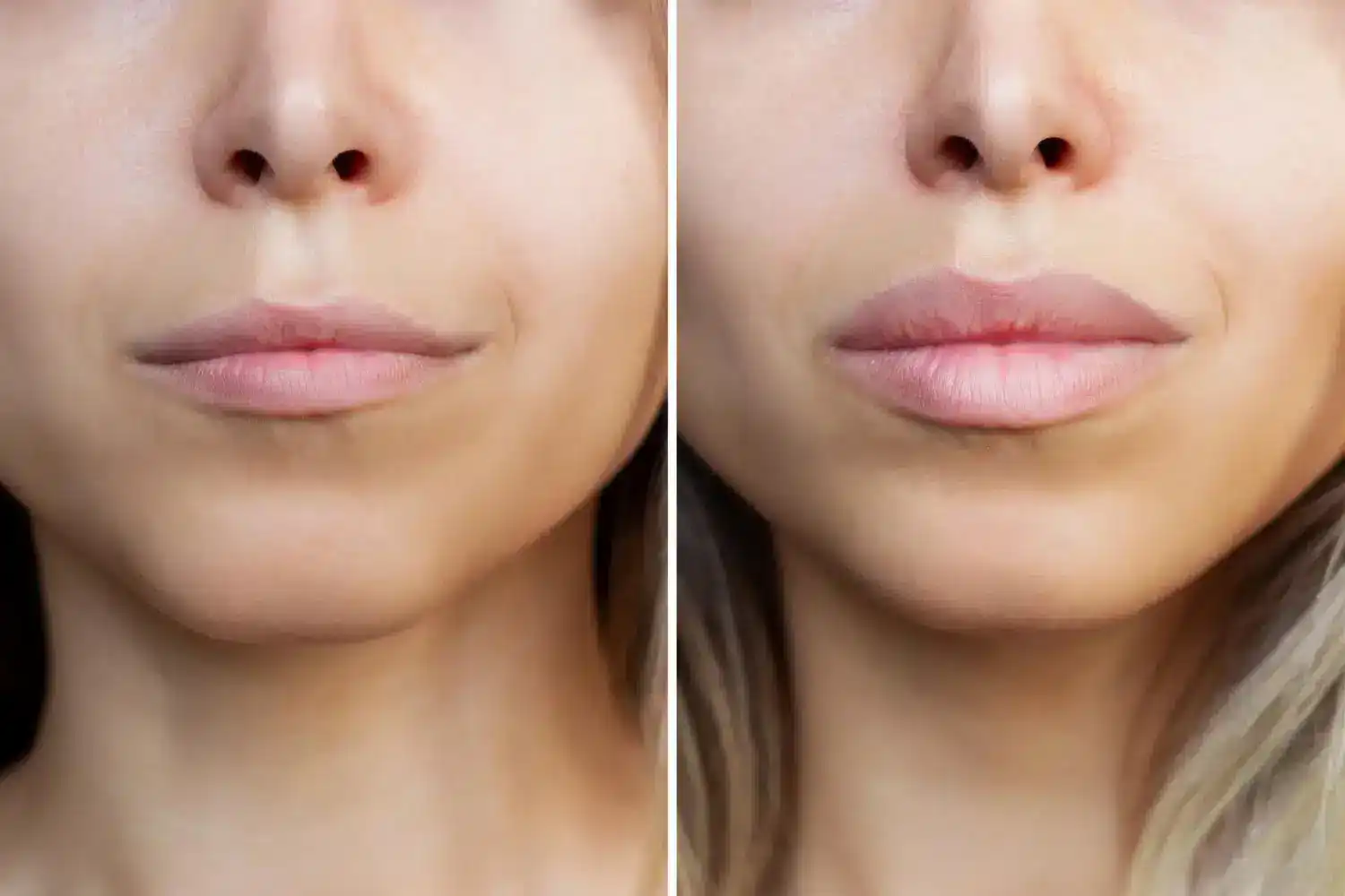 Hochwertige stylage Filler – Jetzt bei MorySkin kaufen